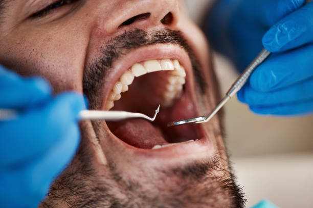 Best Emergency Wisdom Tooth Extraction in Virginia, IL